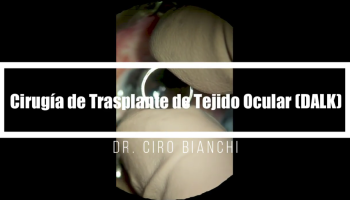 cirugia de trasplante de tejido ocular